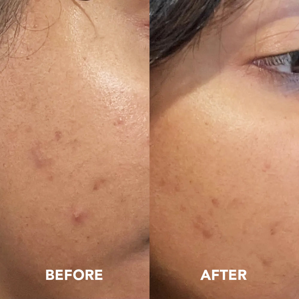 Blemish Spot Serum